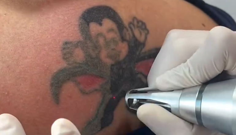 Remoção de tatuagem a laser